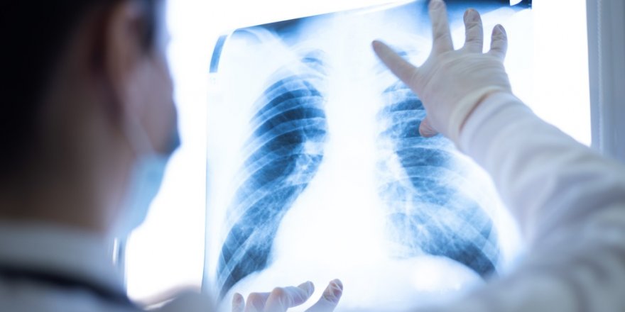 Akciğer Kanseri Bazen Tesadüfen Tespit Edilebiliyor
